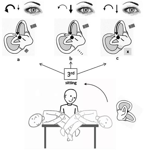 Frontiers Congruous Torsional Down Beating Nystagmus In The Third