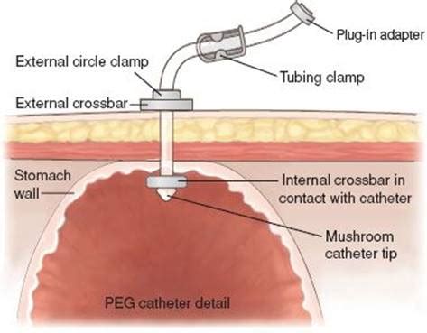 Percutaneous Endoscopic Gastrostomy PEG Tubes Avanos 58 OFF