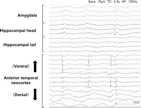 Intraoperative Electrocorticography Using An Epidural Electrode As Download Scientific Diagram