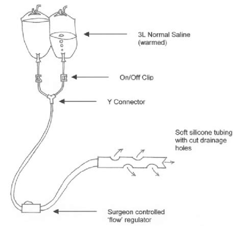 Diagrammatic representation of an abdominal washout system. | Download ...