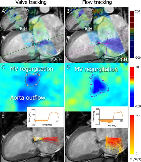 Quantification Of Mitral Valve Regurgitation From 4D Flow MRI Using