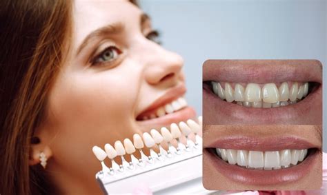 Laminate Veneers In Turkey Cost Pros And Reviews