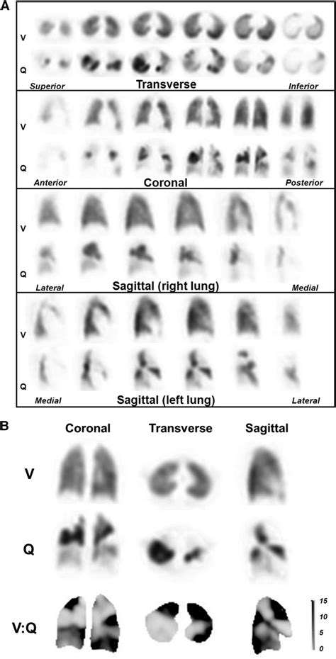 Lung Segments Vq