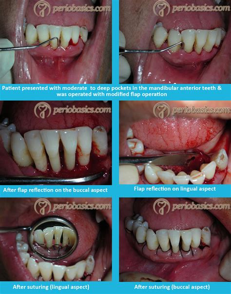 Periodontal Flap Surgeries Current Concepts