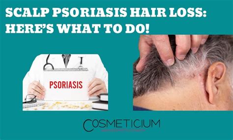 Scalp Psoriasis Hair Loss: Here’s What to Do! - Cosmeticium