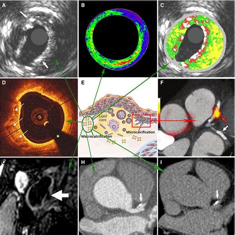 Imaging Cardiovascular Calcification Journal Of The American Heart