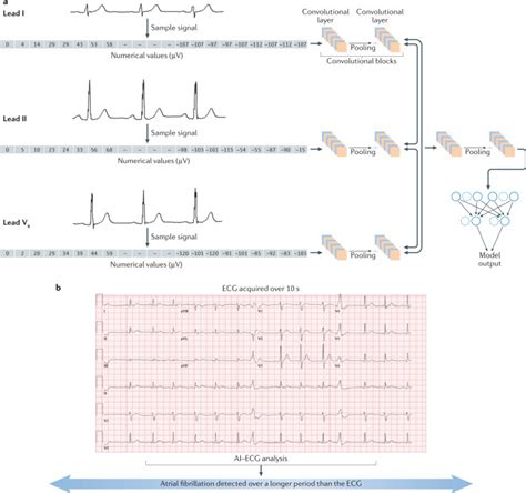 Artificial Intelligence Enhanced Electrocardiography In Cardiovascular