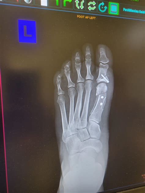 12 days post surgery : r/bunions