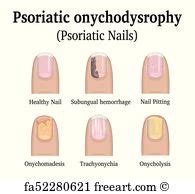 Nail Psoriasis Or Fungal Infection - Nail Ftempo