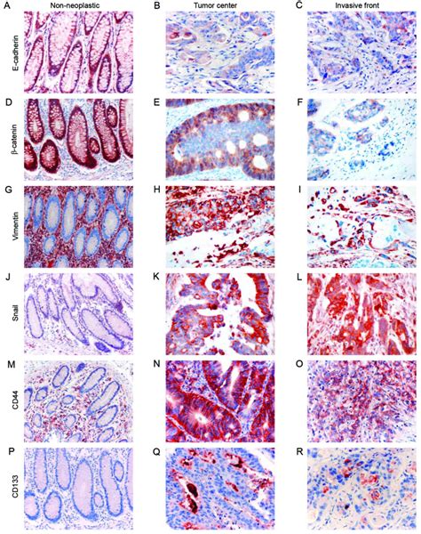 Expression Of Epithelial Mesenchymal Transition And Cancer Stem Cell