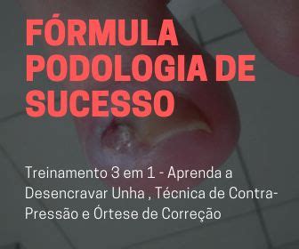 Fórmula Podologia de Sucesso Vale a Pena Como Desencravar Unhas