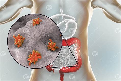 Entamoeba Histolytica Protozoan Infection Of Large Intestine Stock Illustration Illustration