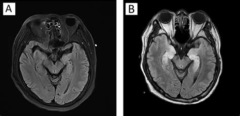 Anti Gabab Receptor Encephalitis Associated With Combined Small Cell Lung Carcinoma Journal Of