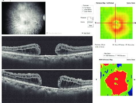 Patient Preoperative Oct Cross Line Horizontal And Vertical Scans Of