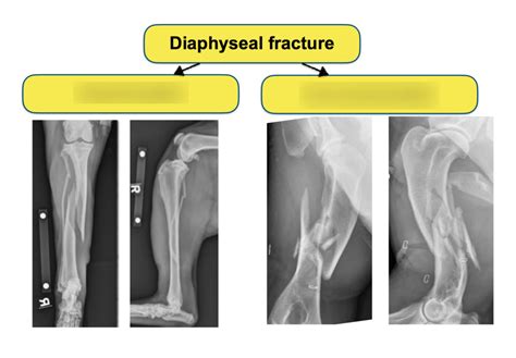 33: Diaphyseal Fracture Treatment I Diagram | Quizlet