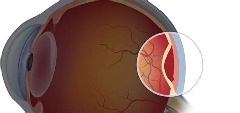 Retinal Detachment Signs Causes Treatments Top Eye Doctor Near Me