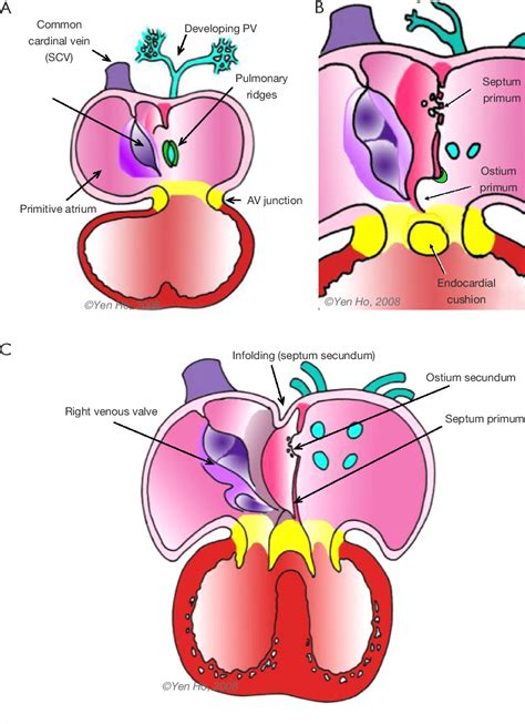 Figure 4 from Anatomy of the atrial septum and interatrial ...