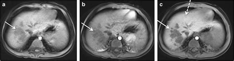 Pre And Postcontrast Axial T Weighted Mr Images With Fat Saturation