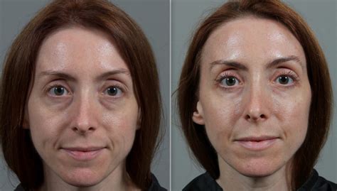 Unpacking The Undereyes Seiler Skin