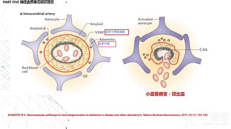 简述ad阿尔兹海默病发病机制、病理生理过程 神经内外 丁香园论坛