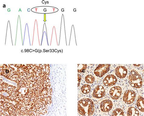 A Lesion Categorized Between Ghost Cell Odontogenic Carcinoma And