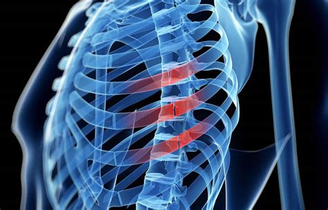 Rib fracture causes, symptoms, diagnosis, healing time & treatment