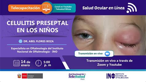 Celulitis Preseptal En Los Ni Os Salud Ocular En L Nea Del Ino Youtube