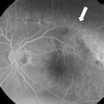 Fundus photograph of the left eye showing myopic disc and posterior ...