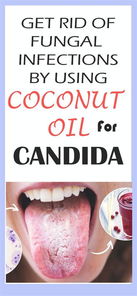 Get Rid Of Fungal Infections By Using Coconut Oil For Candida Health