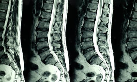 Theres An Alternative To Treating Compression Fractures Pain