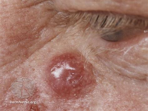 Merkel Cell Carcinoma Physiopedia