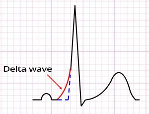 Delta Wave Ecg Book