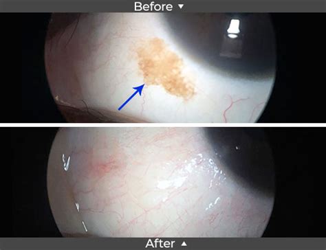 Conjunctival Nevus Removal Before and After Pictures