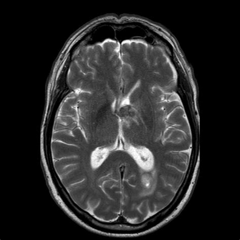 A T1 Weighted Mri High Signal Intensity Lesion Near Caudate Nucleus