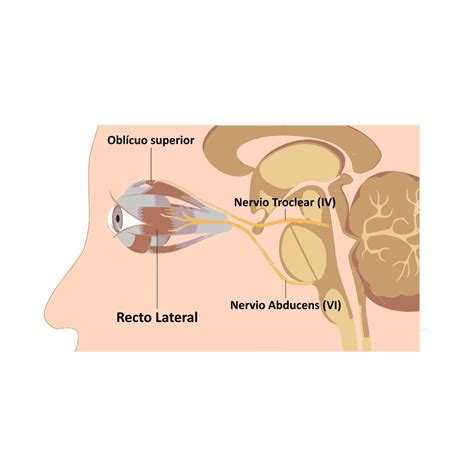 Parálisis del IV nervio craneal Troclear Consulta de Oftalmología