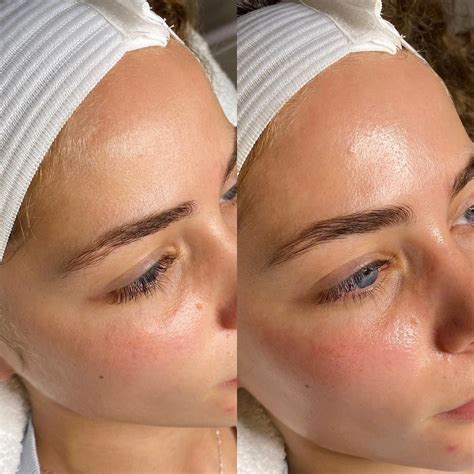 Dermaplane Facial Woodlands Tx Dermaplaning Experts