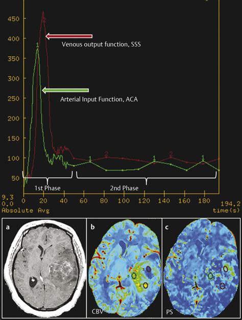 Perfusion Imaging Perfusion Ct Radiology Key