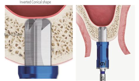 Cas Kit Hiossen Implant