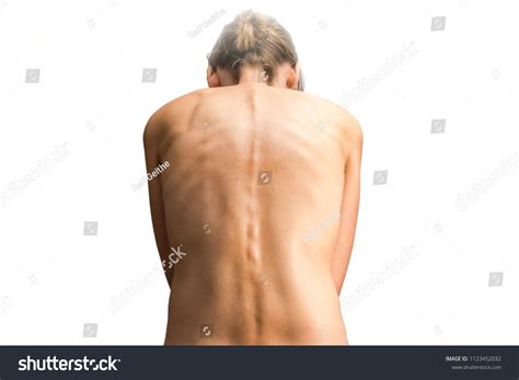 Mujer Desnuda Con Escoliosis Como Diagn Stico Foto De Stock