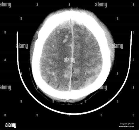 Traumatic Brain Injuries CT Scan Stock Photo Alamy