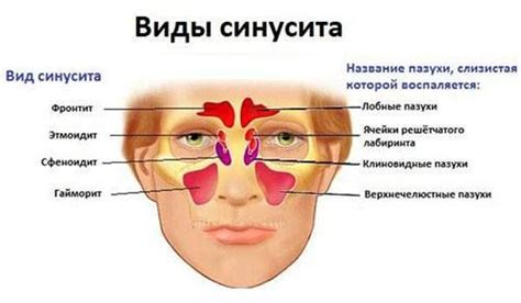 Синусит – лечение в ЦЭЛТ, ЯМИК-процедура.