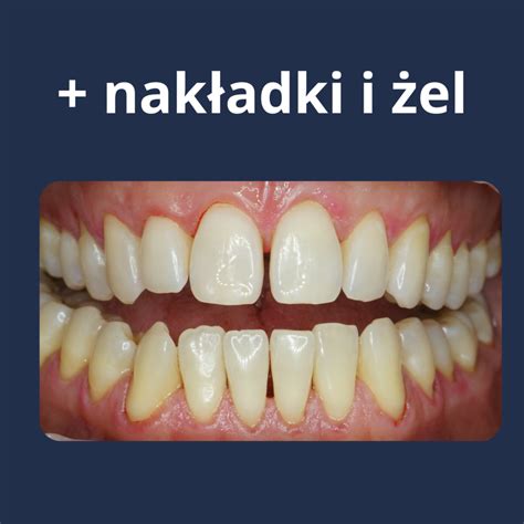 Wybielanie nakładkowe Boutique Dental