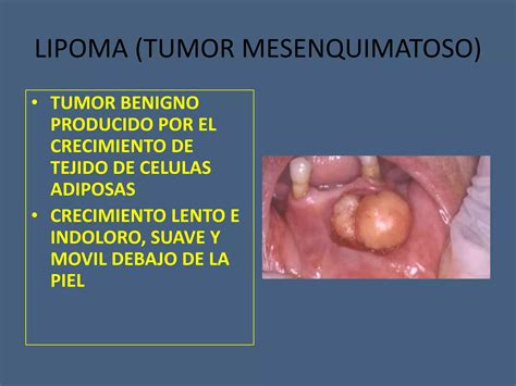 Tumores Benignos Y Malignos De Cavidad Oral Ppt