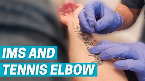 How Can Ims Dry Needling Help Treat Tennis Elbow Youtube