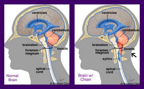 Hanging Low And Invisible What Is Chiari