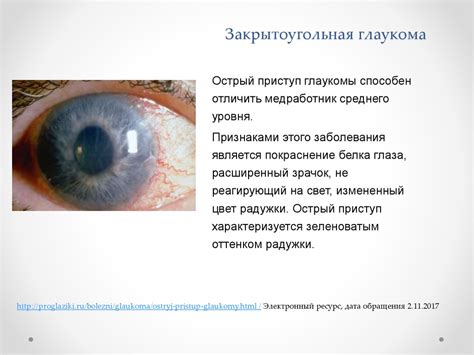 Глаукома: клиника, диагностика - презентация онлайн