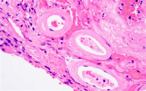 Advancing Diagnostic Criteria For Sporadic Cerebral Amyloid 40 Off