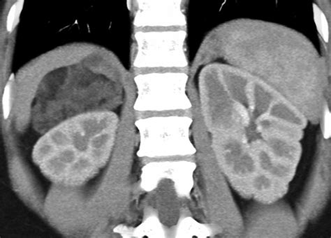 Adrenal Mass Imaging With Multidetector Ct Pathologic Conditions