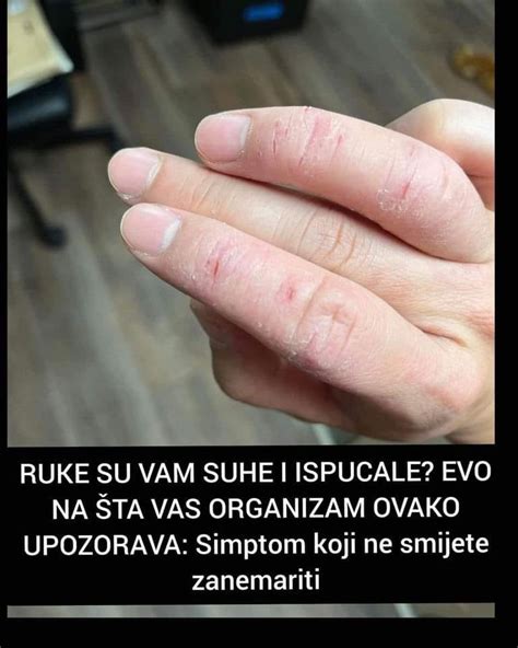 Ako Su Vam Ruke Suhe I Ispucale Evo Na Ta Vas Organizam Ovako Upozora