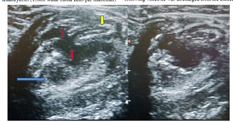 PDF Appendicitis Presenting With Peri Appendiceal Abscess In An Adult